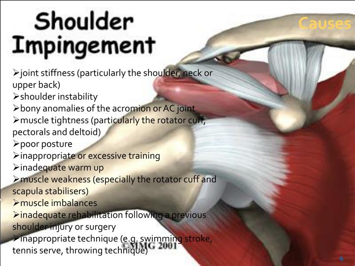 PPT Shoulder Impingement Syndrome PowerPoint Presentation ID2381718