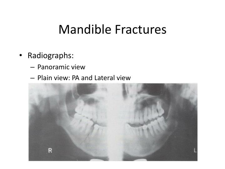 PPT FRACTURES OF MAXILLA AND MANDIBLE PowerPoint Presentation ID