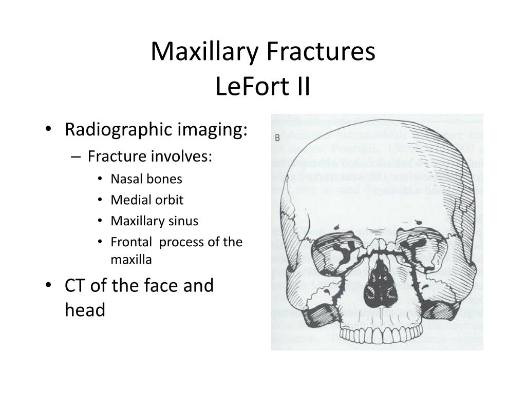 PPT - FRACTURES OF MAXILLA AND MANDIBLE PowerPoint Presentation, free ...