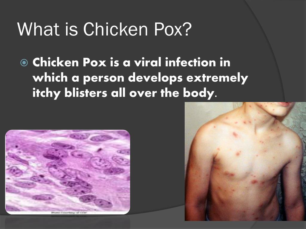 PPT - Chicken Pox PowerPoint Presentation, free download - ID:2395252