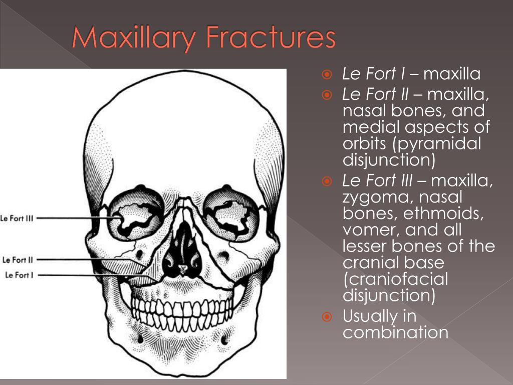 Dental Anterior Maxillary Fracture