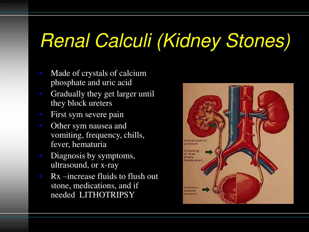 PPT Disorders Of The Urinary System PowerPoint Presentation Free 