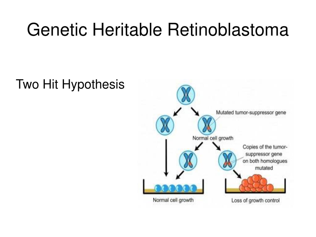 2 hit hypothesis retinoblastoma