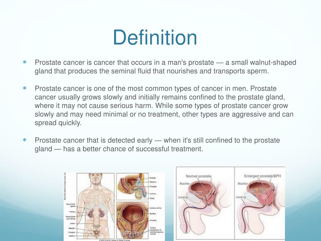 Prostatitis kövek