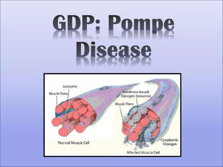 PPT - GDP: Pompe Disease PowerPoint Presentation, free download - ID