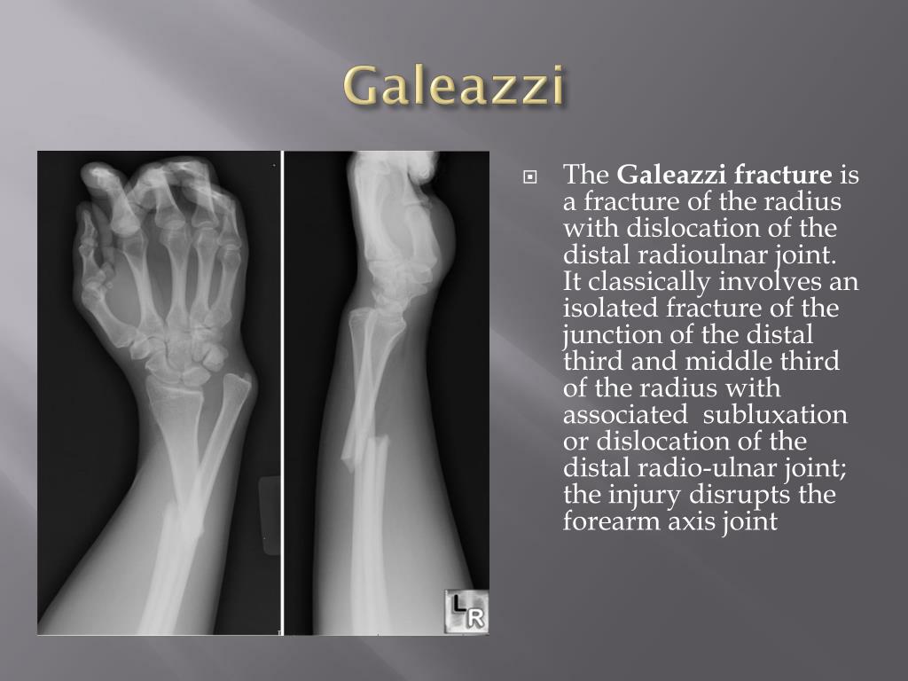 difference between monteggia and galeazzi fracture difference between monteggia and galeazzi fracture