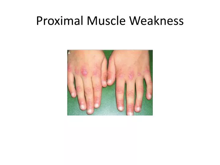 proximal muscle weakness n.