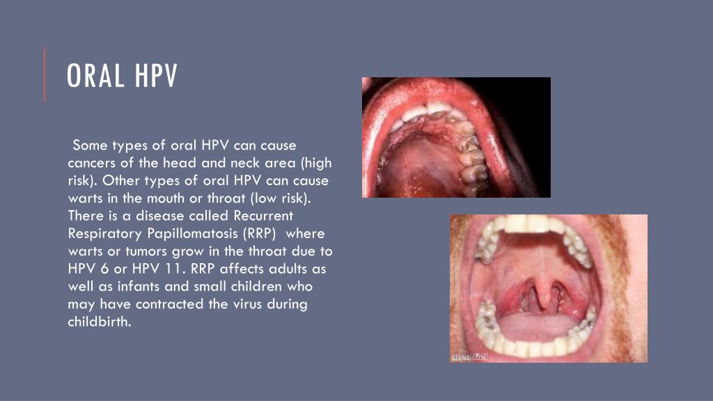 Ppt Hpv Genital Warts Cancer Powerpoint Presentation Free Download