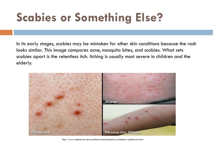 Scabies Stages