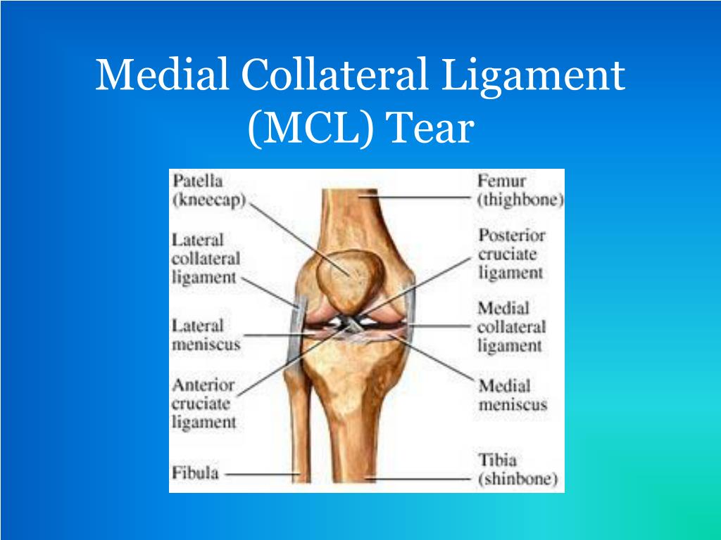 PPT - Medial Collateral Ligament (MCL) Tear PowerPoint Presentation, free  download - ID:2458583