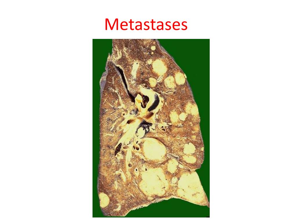 Рак молочной железы метастазы в легких