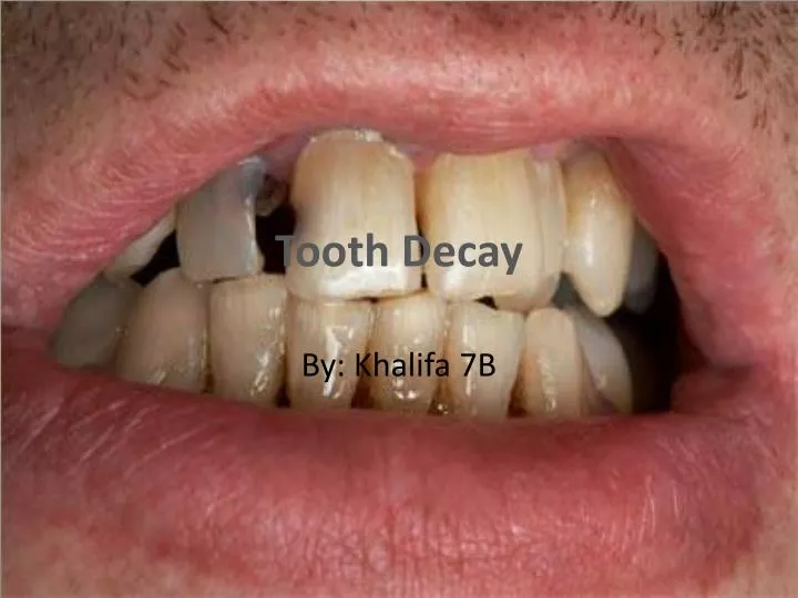 tooth decay n.