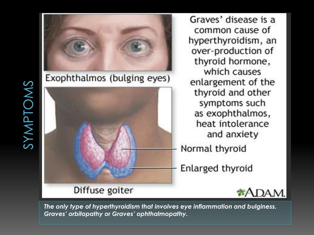 Ppt Graves Disease Powerpoint Presentation Free Download Id2491607