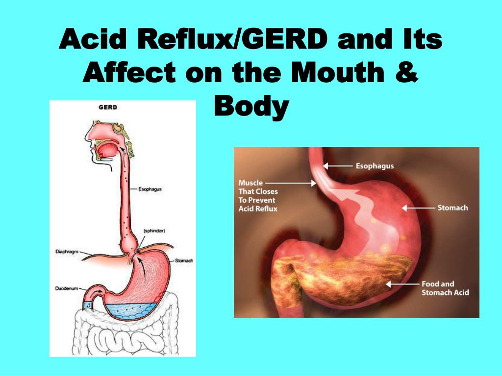 What Is Acid Reflux Disease? At the entrance to your stomach is a valve,  which is a ring of muscle called the lower esophageal sphincter (LES).  Normally, the LES closes as soon