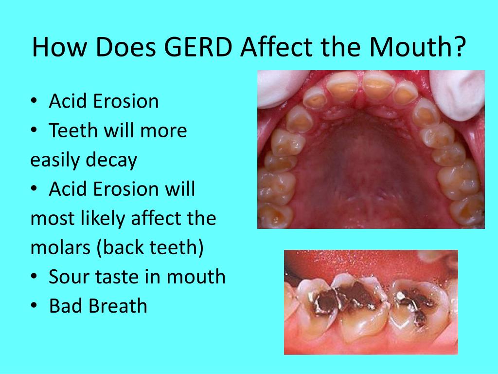 PPT - Acid Reflux/GERD and Its Affect on the Mouth &amp; Body ...
