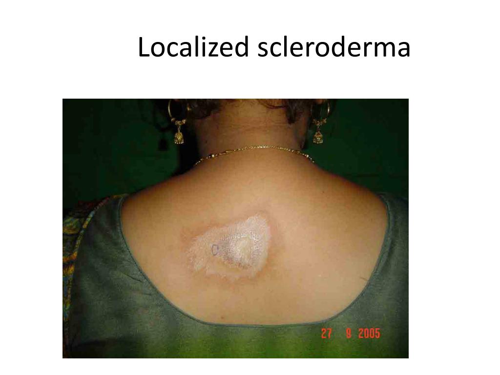 PPT - How to Diagnose Leprosy PowerPoint Presentation ...