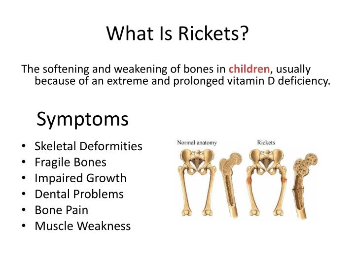 PPT - Rickets Disease PowerPoint Presentation - ID:2568458
