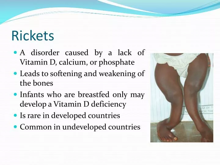 powerpoint presentations on rickets
