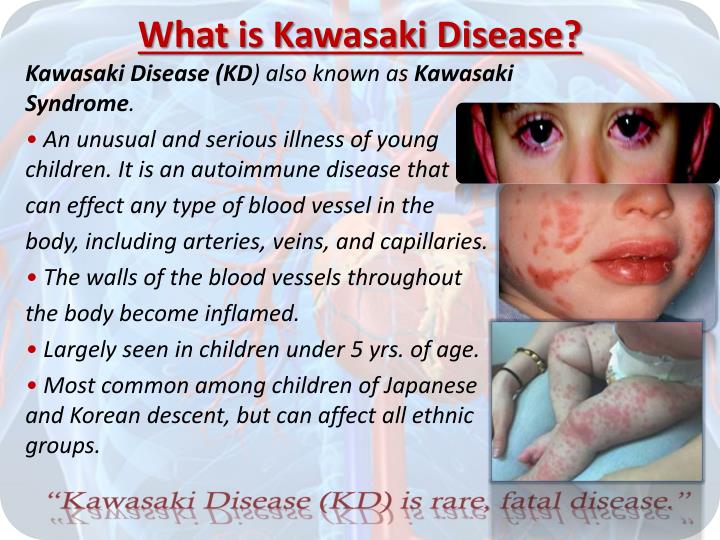 kawasaki disease ppt Kawasaki disease (kd) 2.