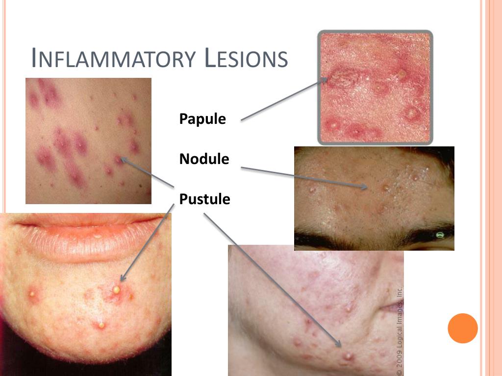 Ppt Acne And Psoriasis Powerpoint Presentation Free Download Id2569650