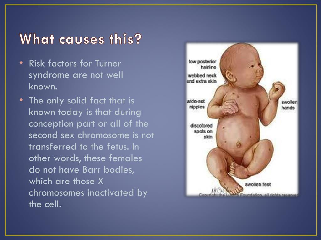 PPT Turner Syndrome PowerPoint Presentation, free download ID2600553