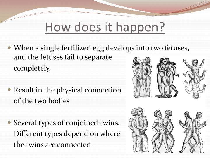 Ppt conjoined twins powerpoint presentation id 2601339