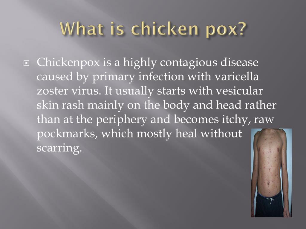 PPT - Chicken pox PowerPoint Presentation, free download - ID:2604004