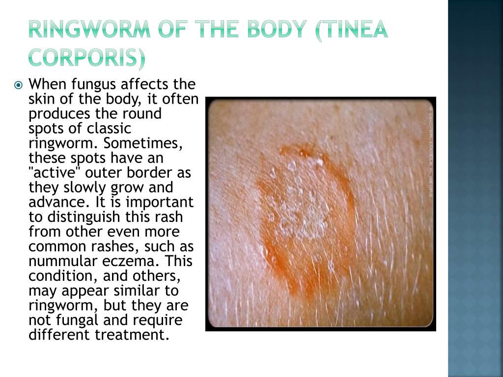 TINEA CORPORIS (RINGWORM OF THE BODY)