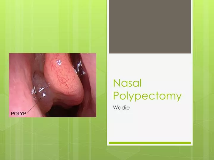 nasal polypectomy n.