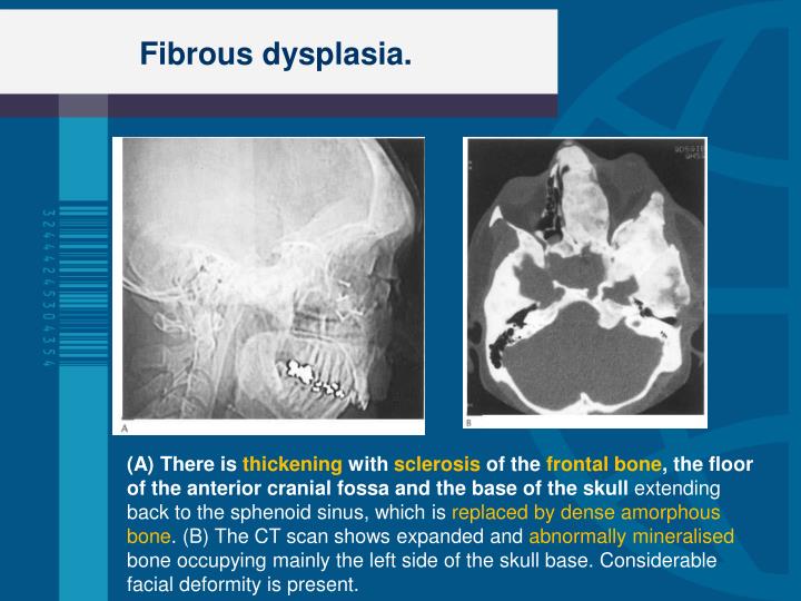PPT - FIBROUS DYSPLASIA (FD) PowerPoint Presentation - ID:2637822