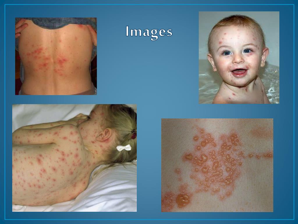 PPT - Chicken Pox and Shingles PowerPoint Presentation, free download