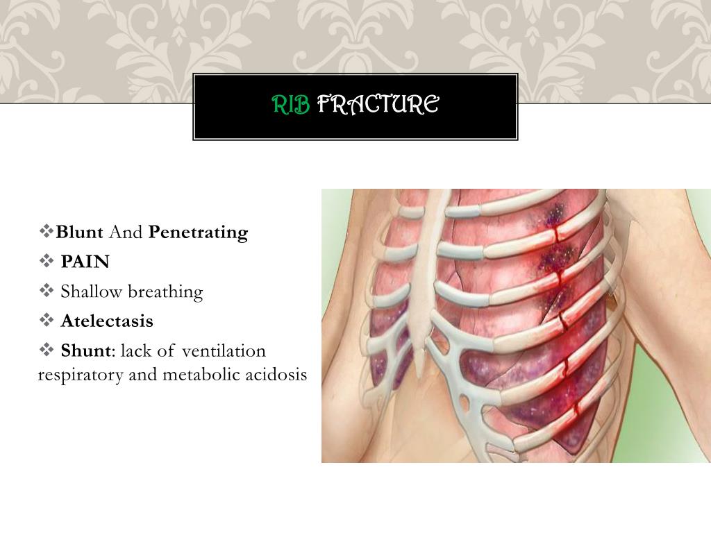 PPT chest trauma PowerPoint Presentation, free download