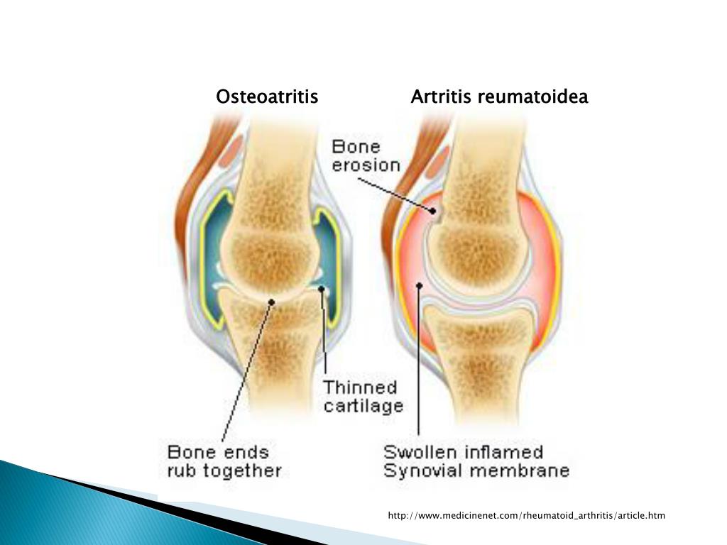 Artritis reumatoide y artrosis