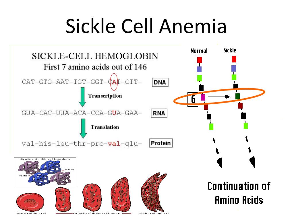 simplemind map for sickle cell anemia simplemind map for sickle cell anemia