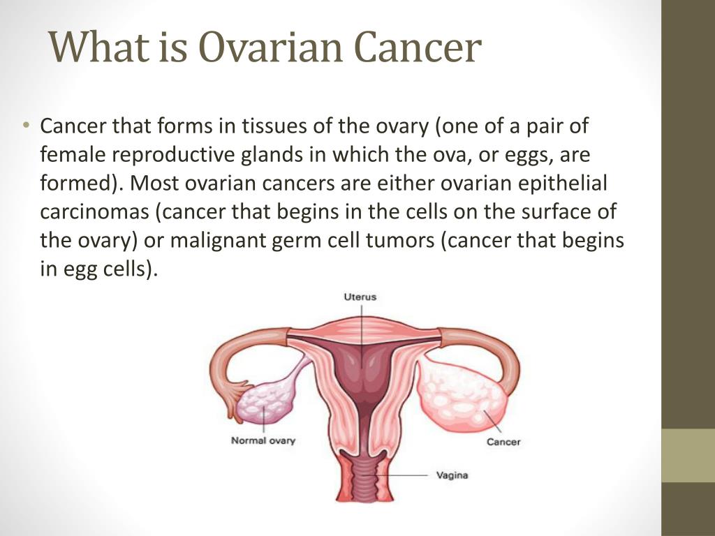 powerpoint presentation on ovarian cancer