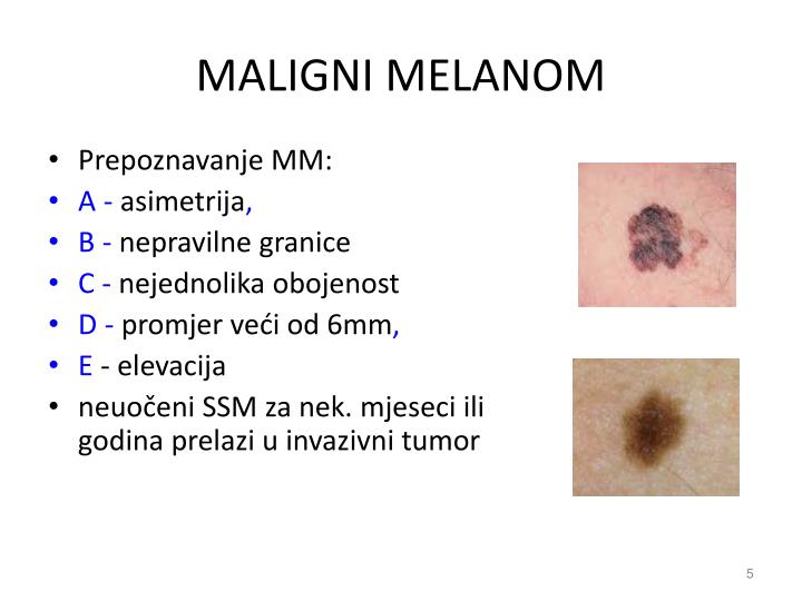 PPT - ZLOĆUDNI TUMORI KOŽE PowerPoint Presentation - ID:2674856