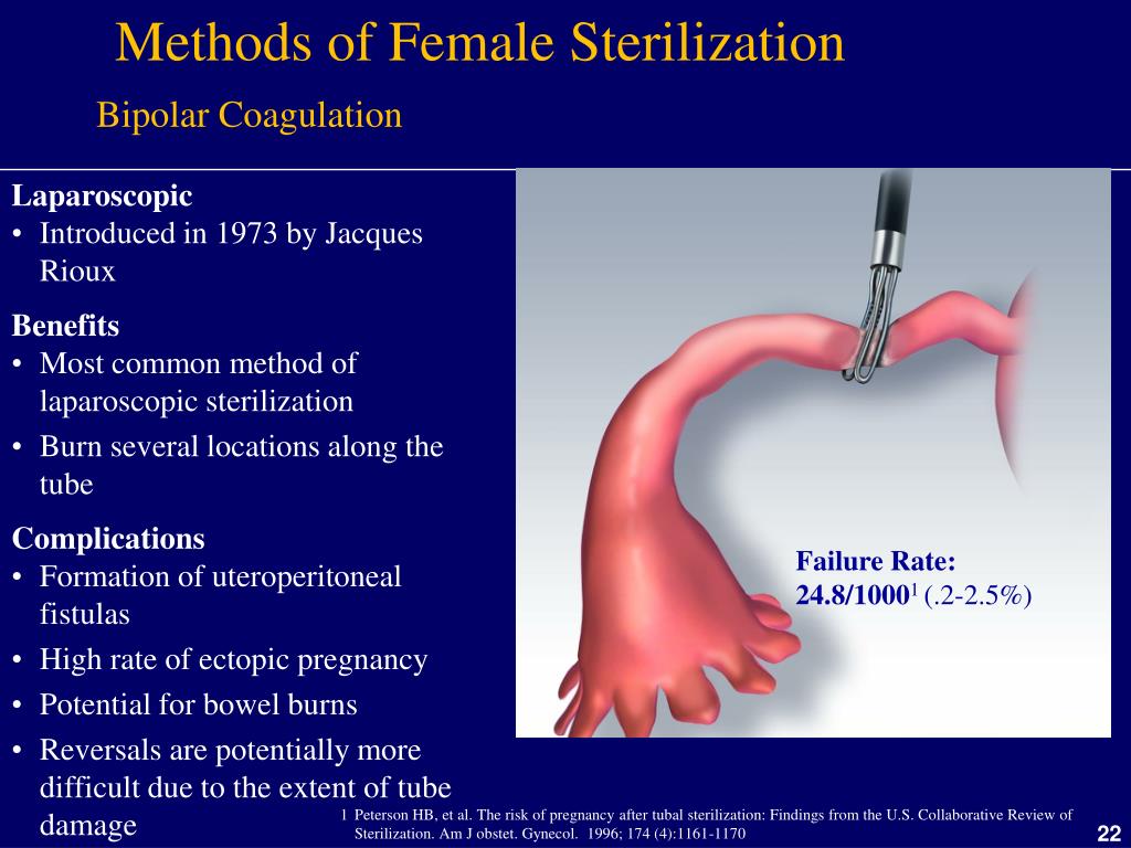Methods of Female Sterilization. 