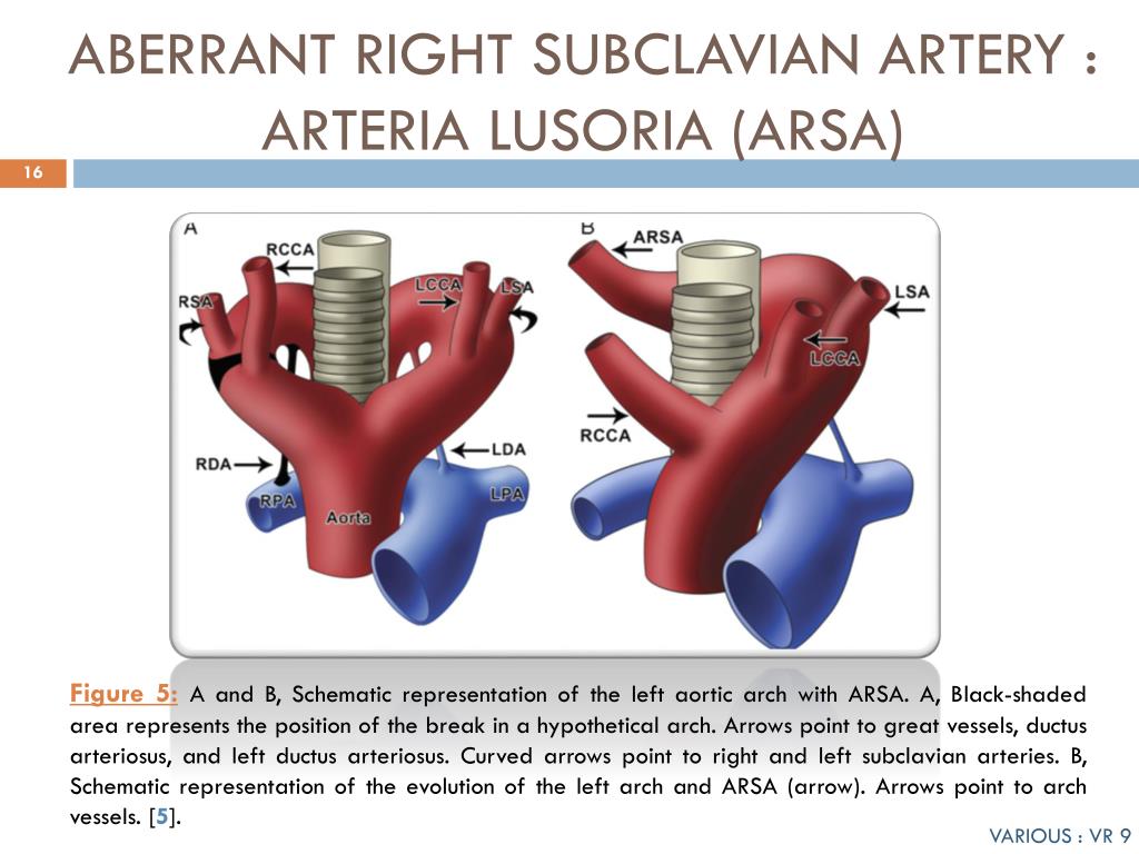 Правая аберрантная артерия. Артерия люзория. Правая аберрантная подключичная артерия у плода. Правая аберрантная подключичная артерия у ребенка.