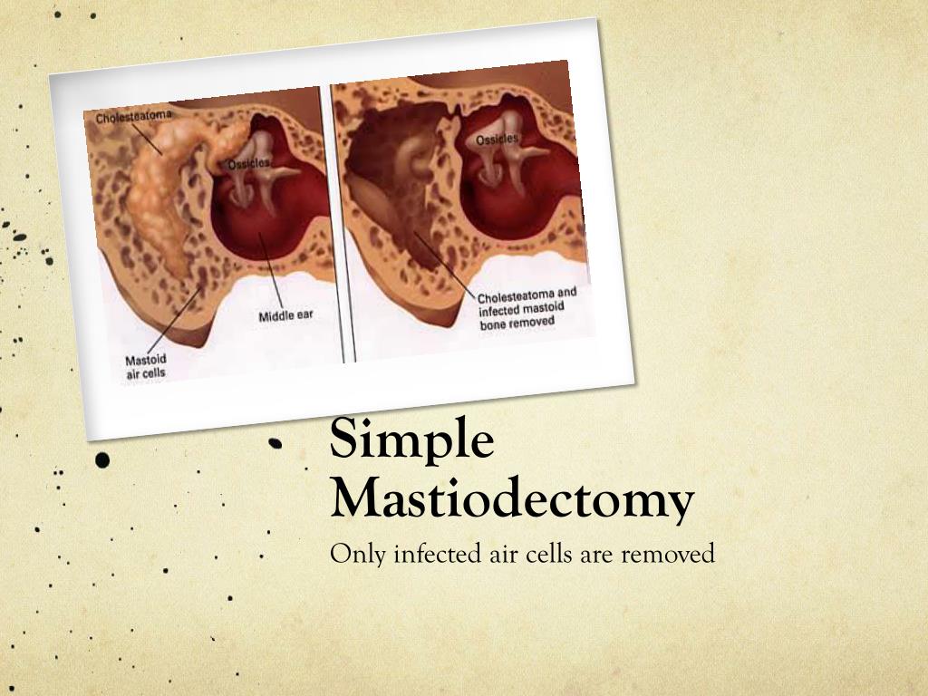 Ppt Mastoidectomy Powerpoint Presentation Free Download Id