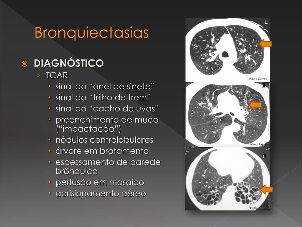 PPT - BRONQUIECTASIAS: DA DEFINIÇÃO À INVESTIGAÇÃO SISTEMATIZADA DA SUA ...