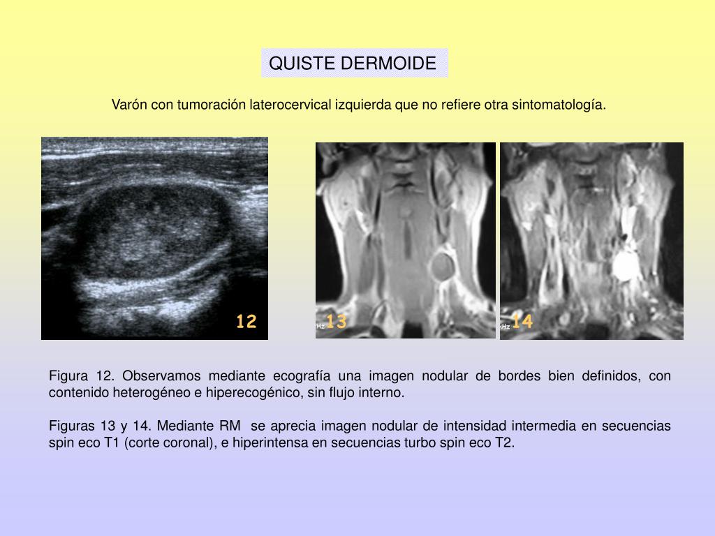 PPT LESIONES QU STICAS CERVICALES UTILIDAD DE LAS PRUEBAS DE IMAGEN ppt-lesiones-qu-sticas-cervicales-utilidad-de-las-pruebas-de-imagen