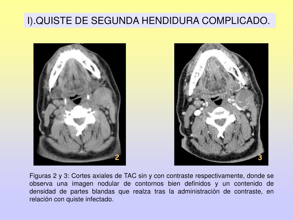 PPT LESIONES QU STICAS CERVICALES UTILIDAD DE LAS PRUEBAS DE IMAGEN ppt-lesiones-qu-sticas-cervicales-utilidad-de-las-pruebas-de-imagen