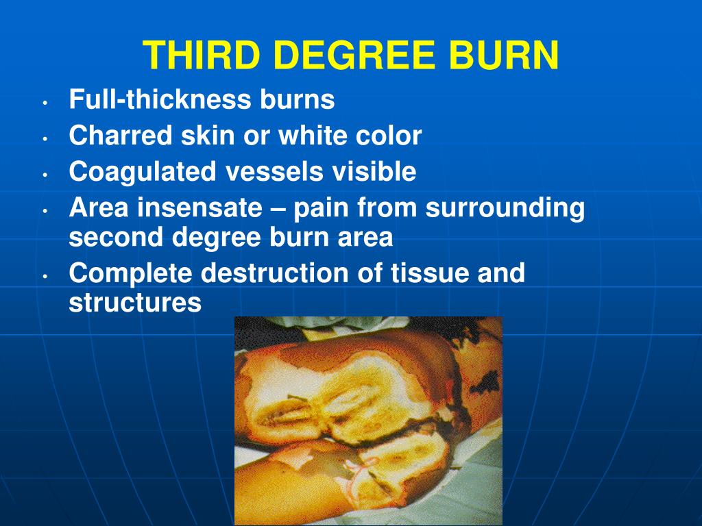 4th degree burn on face 4th degree burn on face