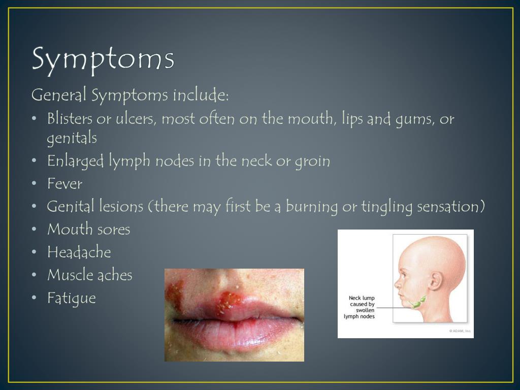 presentation of herpes simplex virus 1