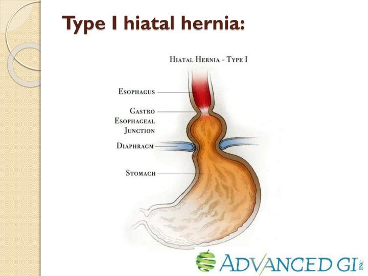 PPT - Endoscopic Diagnosis of Hiatal Hernia PowerPoint Presentation ...