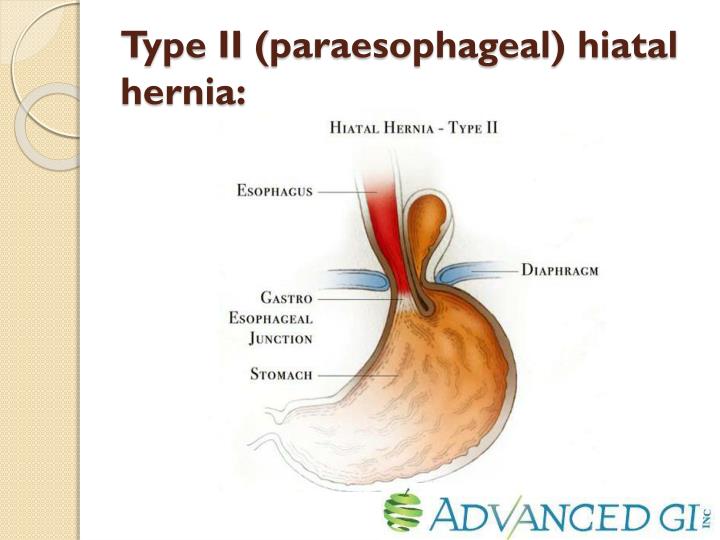 PPT - Endoscopic Diagnosis of Hiatal Hernia PowerPoint Presentation ...