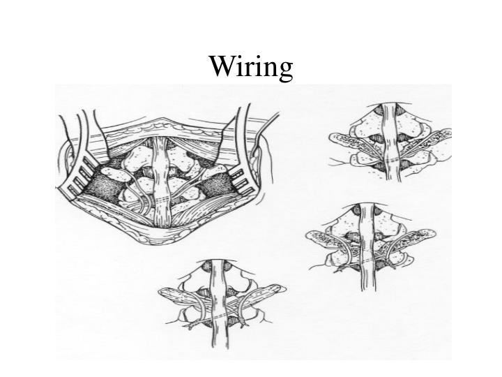 lysis or listhesis lysis or listhesis