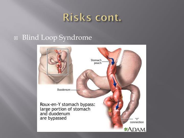 PPT RouxenY Gastric Bypass PowerPoint Presentation ID2728292
