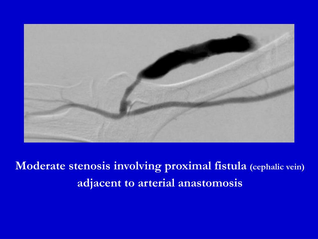 PPT Patient has a right brachiocephalic fistula with increased venous