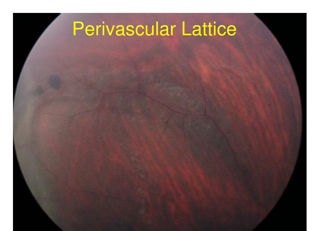 symptoms of lattice degeneration symptoms of lattice degeneration